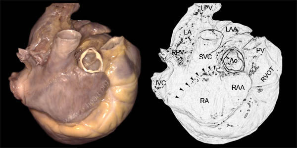 Right Atrium Lateral